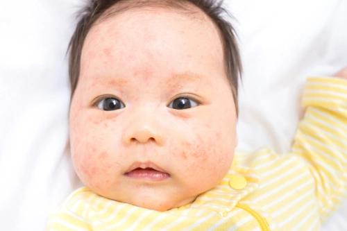 Alergi Makanan pada Bayi: Gejala & Cara Atasi