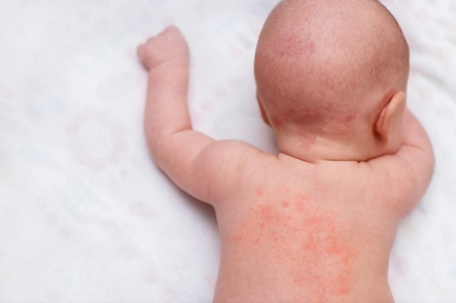 12 Cara Mengatasi Biang Keringat pada Bayi yang Aman
