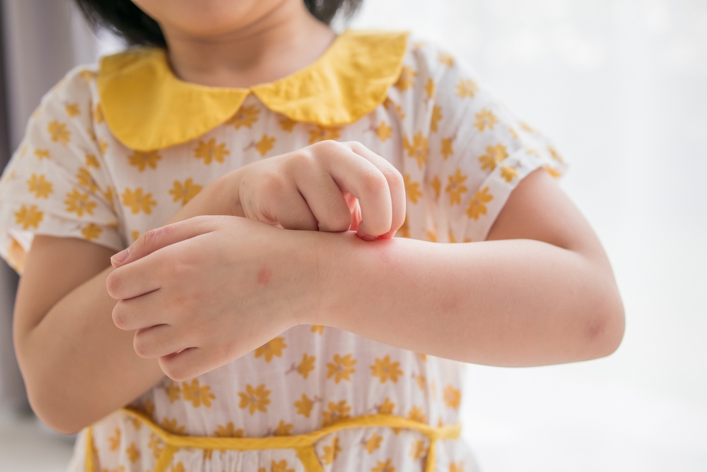 Anak Alergi Makanan? Ini Cara Aman Mengatasinya
