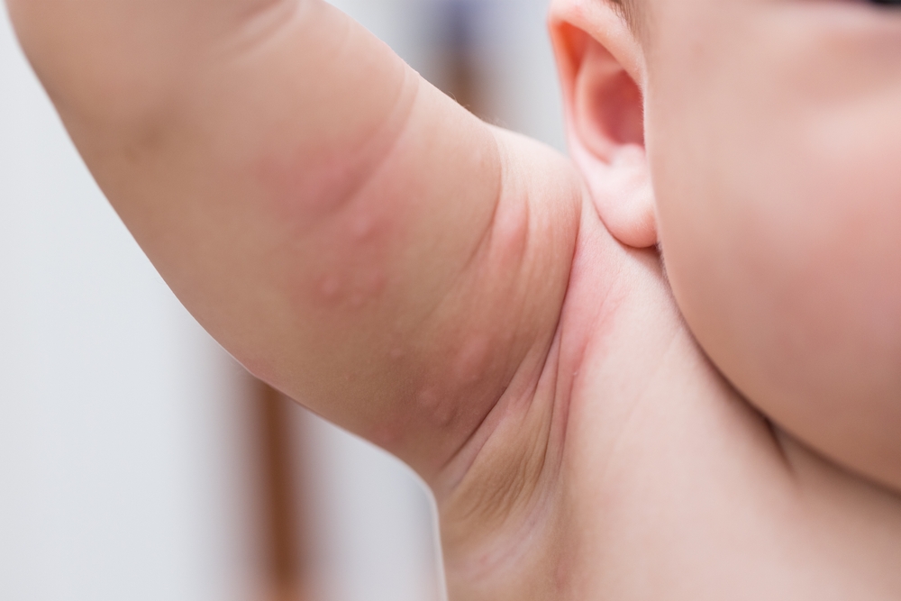 Bentol Merah pada Bayi: 7 Cara Menghilangkan