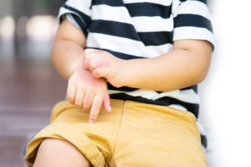 8 Jenis Alergi pada Anak + Cara Mengenalinya